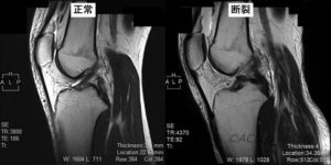 前十字靱帯(ACL)とは何ですか?